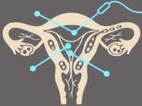 لاپاراسکوپی