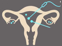 هیستروسکوپی