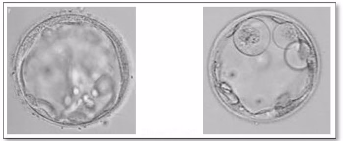 تصویر جنین 5 روزه - جنین با کیفیت ضعیف