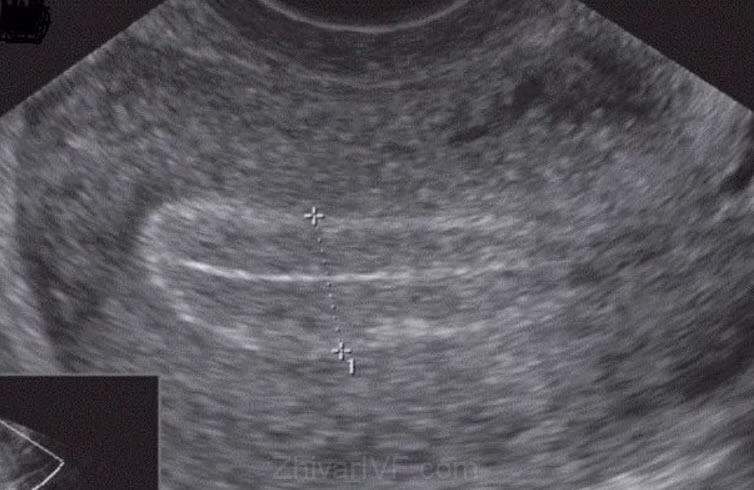 تصویر رحم با الگوی سه خطی در سونوگرافی ترانس واژینال