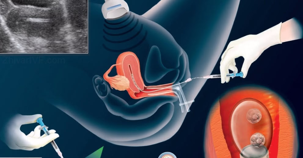 تصویری از نحوه انتقال جنین به رحم مادر 