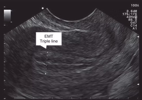 تصویر سونوگرافی از یک رحم با آندومتر سه خطی که ضخامت آن در تصویر با خط چین سفید نمایش داده شده است.